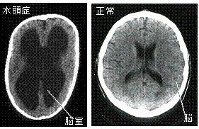 水頭症CT画像