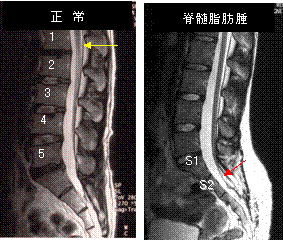 腰椎MRI画像