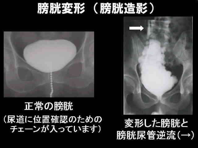 膀胱変形の写真