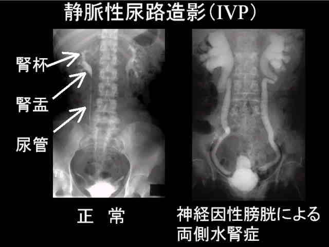 静脈性尿路造影の写真