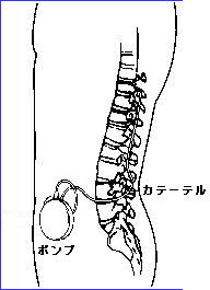 髄腔内薬物治療